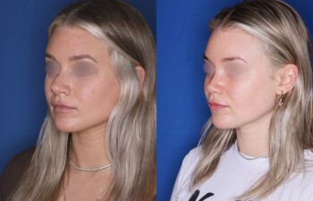 Before and after rhinoplasty of a 25-year-old female, 2 months post-op at Kalos Plastic Surgery, left oblique view