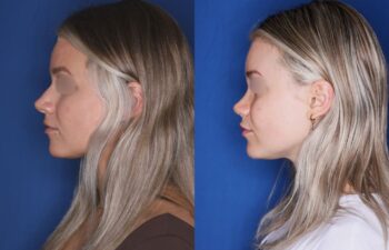 Before and after rhinoplasty of a 25-year-old female, 2 months post-op at Kalos Plastic Surgery, left view