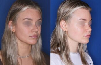 Before and after rhinoplasty of a 25-year-old female, 2 months post-op at Kalos Plastic Surgery, right oblique view