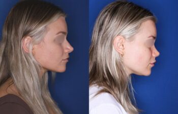 Before and after rhinoplasty of a 25-year-old female, 2 months post-op at Kalos Plastic Surgery, right view