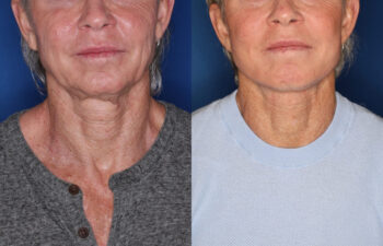 62 year old male 10 months post KalosLift extended deep plane facelift with platysmaplasty neck lift