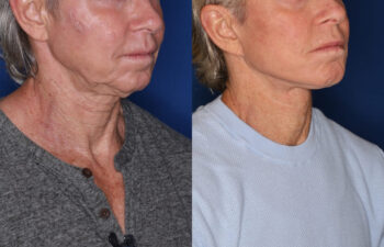 62 year old male 10 months post KalosLift extended deep plane facelift with platysmaplasty neck lift