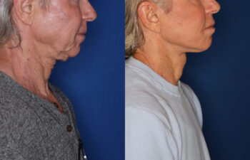 62 year old male 10 months post KalosLift extended deep plane facelift with platysmaplasty neck lift