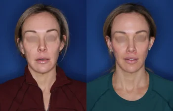 40 year old female 4 months post perialar lip lift