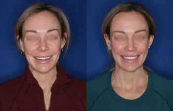 40 year old female 4 months post perialar lip lift