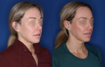 40 year old female 4 months post perialar lip lift