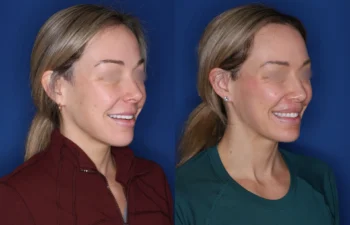 40 year old female 4 months post perialar lip lift