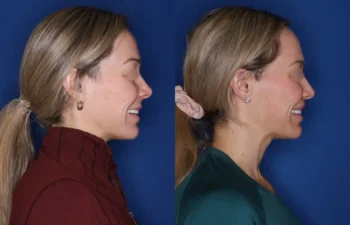 40 year old female 4 months post perialar lip lift