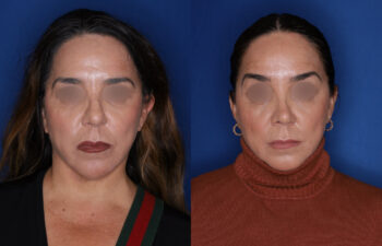 49 year old female 5 months post rhinoplasty