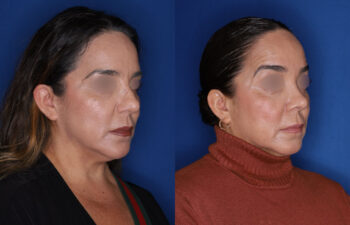 49 year old female 5 months post rhinoplasty