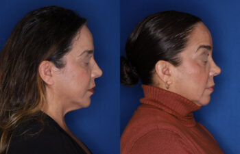 49 year old female 5 months post rhinoplasty