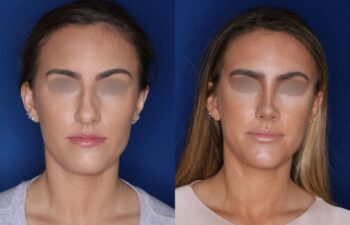 Before and after rhinoplasty results, 27-year-old female patient, 4 months post-surgery at Kalos Plastic Surgery, front view.