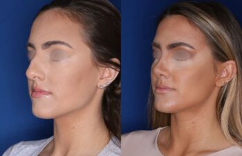 Before and after rhinoplasty results, 27-year-old female patient, 4 months post-surgery at Kalos Plastic Surgery, left oblique view.