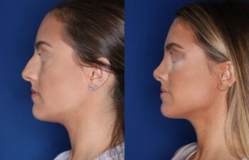 Before and after rhinoplasty results, 27-year-old female patient, 4 months post-surgery at Kalos Plastic Surgery, left side view.