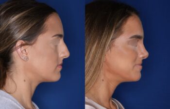 Before and after rhinoplasty results, 27-year-old female patient, 4 months post-surgery at Kalos Plastic Surgery, right side view.