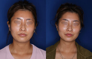 Side-by-side comparison of a woman before and after a cosmetic procedure, showing subtle changes in facial contours and expression against a blue background.