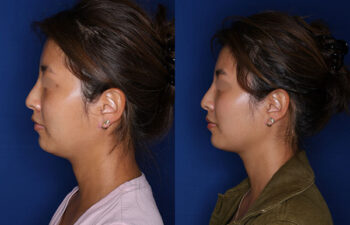 Side-by-side profile photos of a woman before and after a cosmetic procedure, showing changes to her jawline and neck.