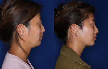 Side-by-side profile images of a woman before and after a cosmetic procedure, showing a reduced double chin and more defined jawline in the after photo.