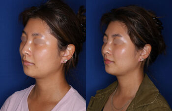 Side-by-side comparison of a woman before and after a cosmetic procedure, showing changes in facial contour; both images have a blue background and the woman’s eyes are blurred.