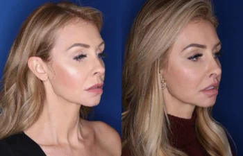 38 year old female 4 months post perialar lip lift