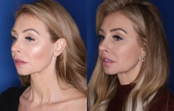 38 year old female 4 months post perialar lip lift