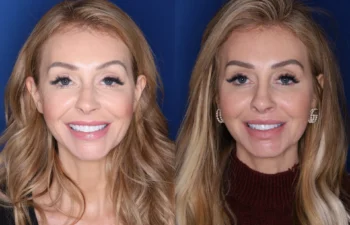 38 year old female 4 months post perialar lip lift