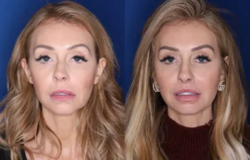 38 year old female 4 months post perialar lip lift