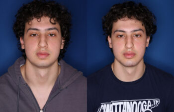 20 year old male 5 weeks post silicone chin implant