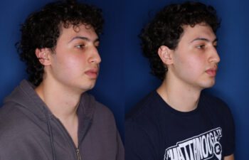 20 year old male 5 weeks post silicone chin implant