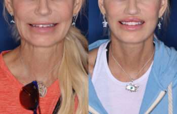 51 year old female 3 months post KalosLift extended deep plane facelift with platysmaplasty neck lift and Perialar lip lift