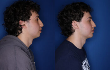 20 year old male 5 weeks post silicone chin implant