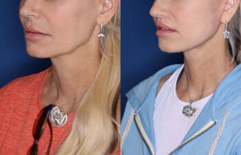 51 year old female 3 months post KalosLift extended deep plane facelift with platysmaplasty neck lift and Perialar lip lift