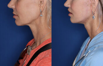 51 year old female 3 months post KalosLift extended deep plane facelift with platysmaplasty neck lift and Perialar lip lift