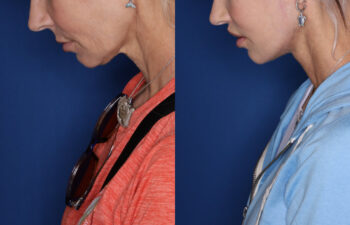 51 year old female 3 months post KalosLift extended deep plane facelift with platysmaplasty neck lift and Perialar lip lift