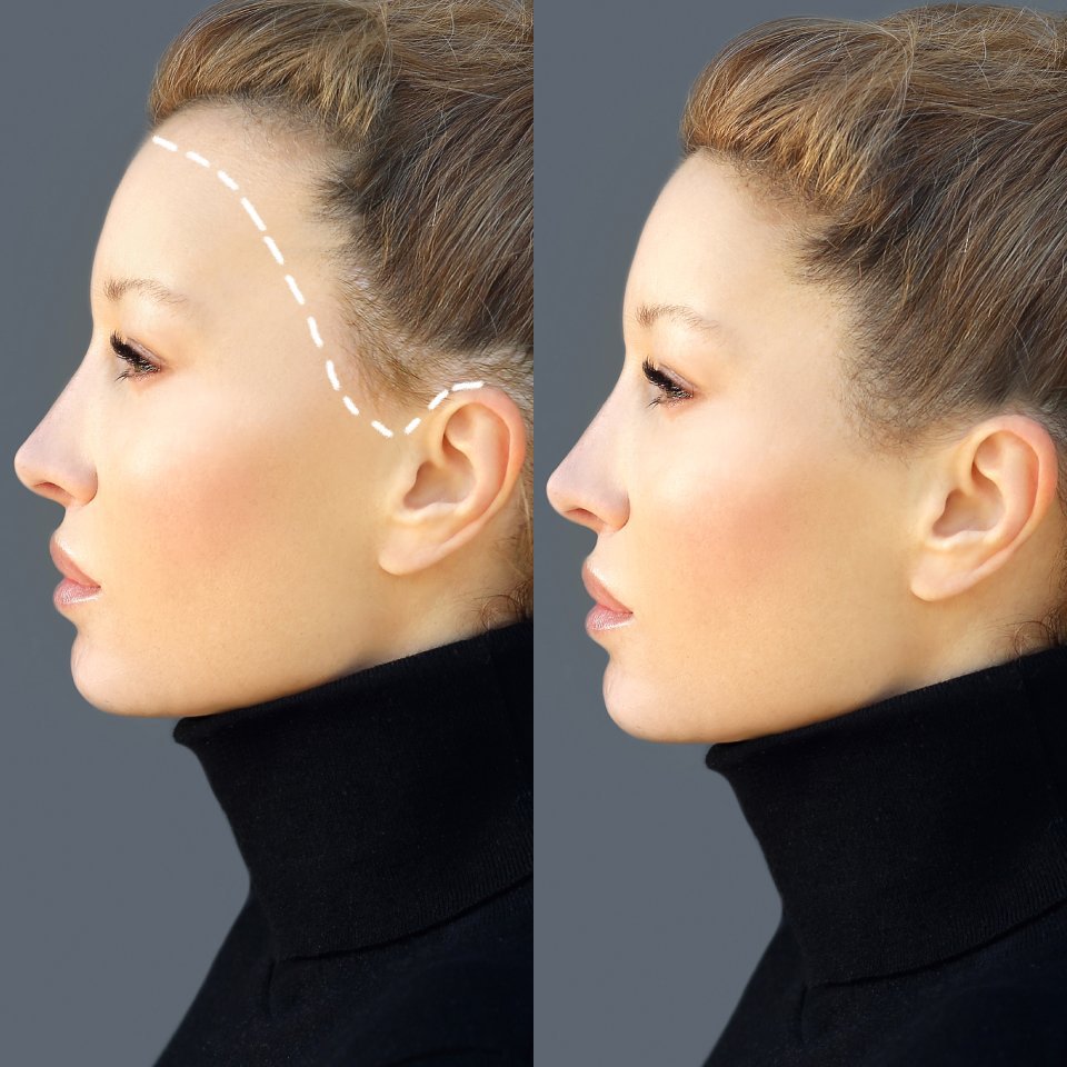 Female pattern baldness, Treatment for hair loss, Hair transplant