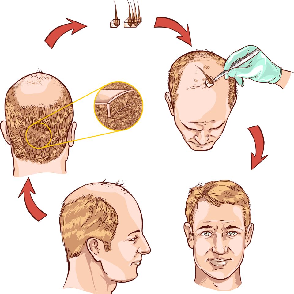 Follicular Unit Extraction (FUE) procedure