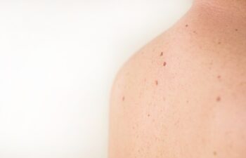 Close up detail of the bare skin on a man back with scattered moles and freckles. Checking benign moles. Sun effect on skin. Birthmarks on skin
