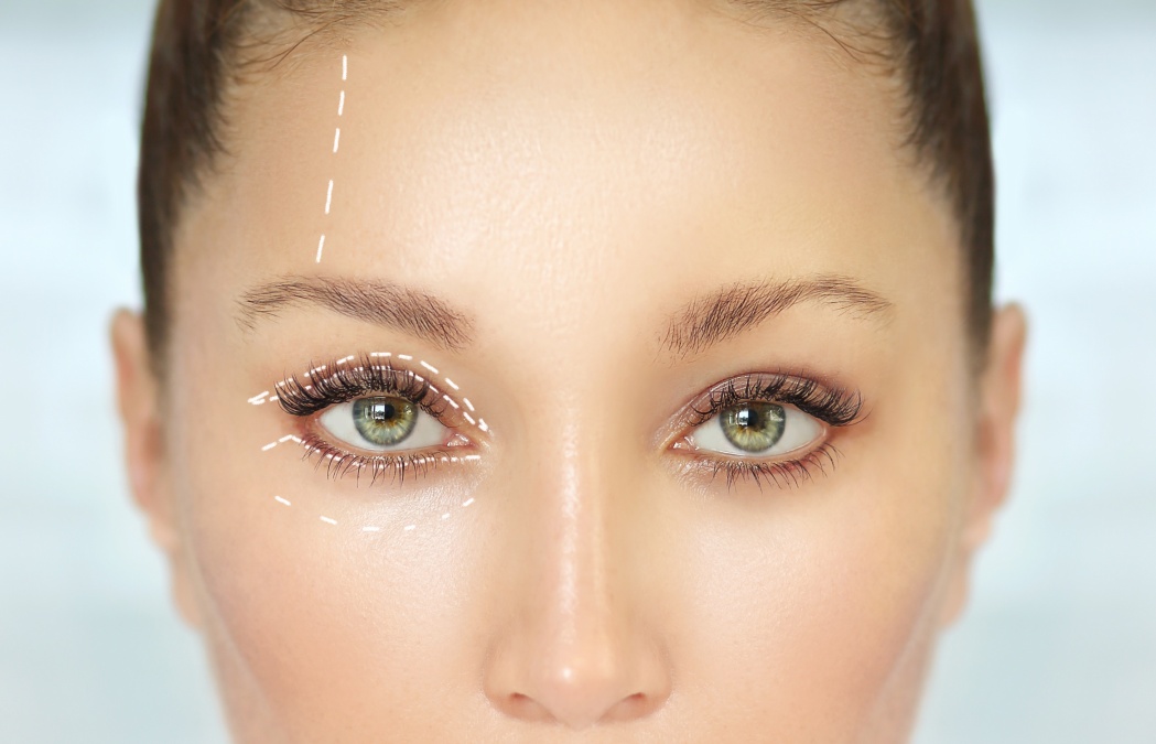 Upper Eyelid Lift with Local Anesthesia | Atlanta, GA