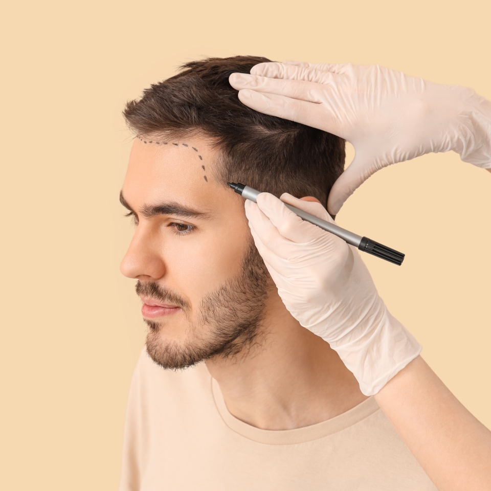 Doctor marking young man's forehead with hair loss problem on beige background, closeup