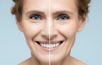 Woman's face before and after skin tightening and anti-aging procedures. Remove of wrinkles, nasolabial folds, skin rejuvenation procedure