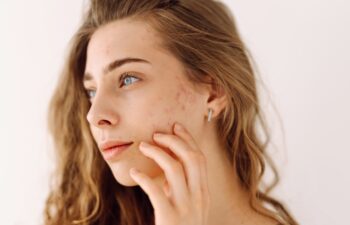 Portrait of a young girl with problem skin. Pimples, acne, pores, scars. Natural skin. Problem skin skincare.