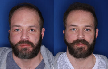 37 year old male 7 months post 2,500 graft transplant