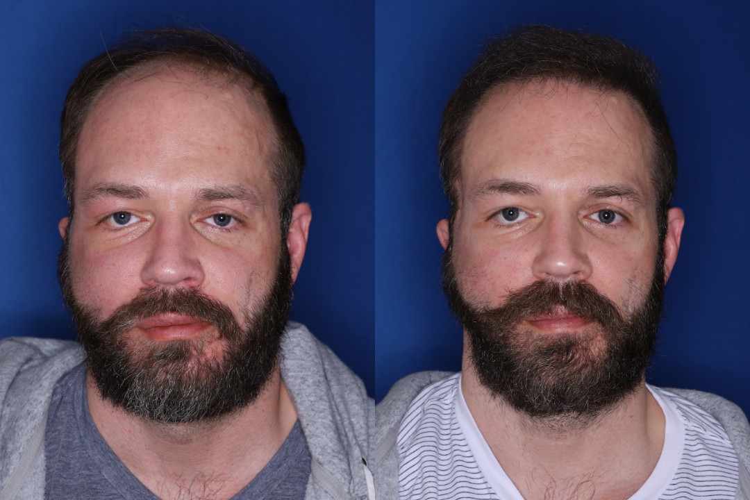 37 year old male 7 months post 2,500 graft transplant