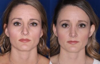 Side-by-side photos show the same woman before and after a cosmetic procedure, with subtle changes in facial appearance and makeup.