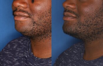 Side-by-side close-up images of a man's lower face and neck, showing different angles of his beard and skin texture against a blue background.