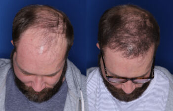 37 year old male 7 months post 2,500 graft transplant