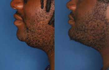 Side-by-side profile images of a man's lower face and neck before (left) and after (right) a cosmetic procedure, showing reduced chin fullness against a blue background.