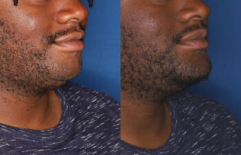 Side-by-side close-up of a man's lower face and neck, showing a comparison before and after facial hair grows fuller. Background is blue, and he is wearing a blue patterned shirt.