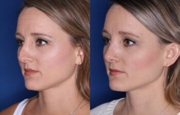 Side-by-side images show a woman before and after a cosmetic procedure, with subtle changes in skin smoothness and facial contour.