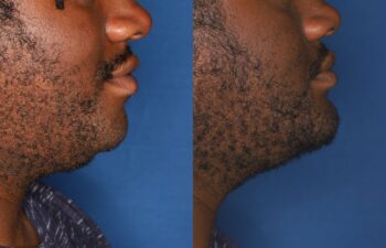 Side-by-side profile photos of a person's lower face and neck showing a reduction in submental fullness from left (before) to right (after) against a blue background.